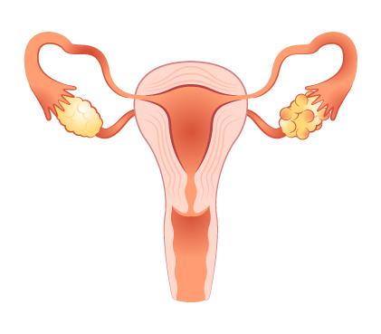 PCOD/PCOS